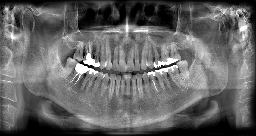 Imagen de radiografía dental panorámica